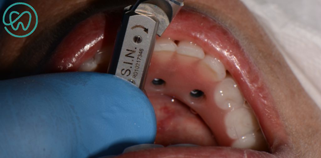 parafusamento da protese dentária com torquímetro
