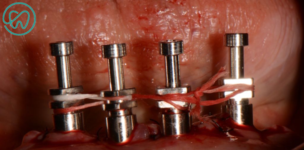 protese dentaria tipo protocolo uniao dos mini pilares com fiodental
