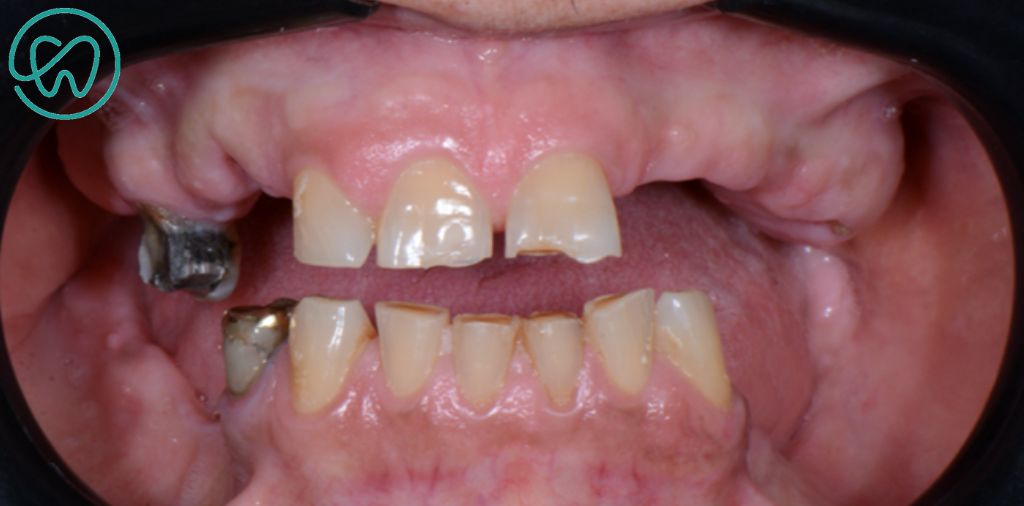prótese dento-gengival