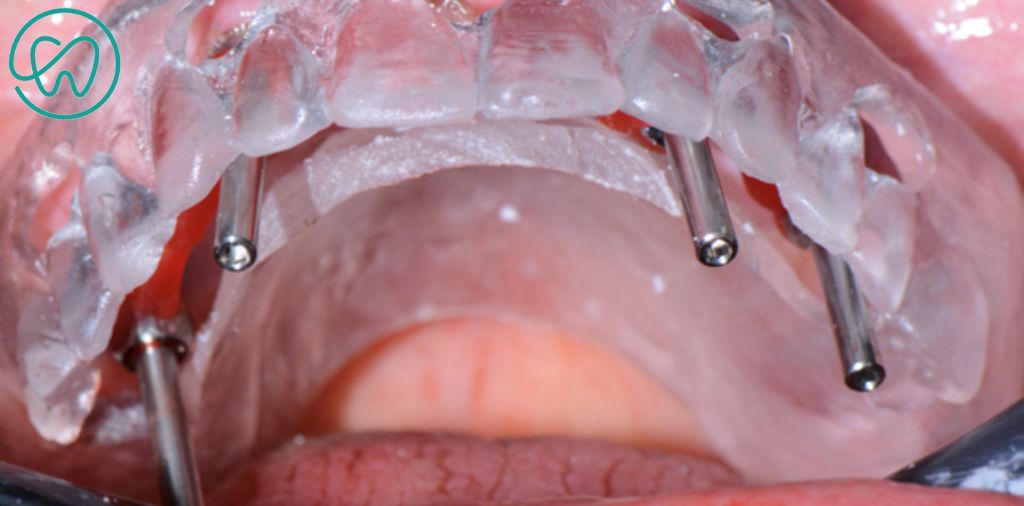 remoção dos dentes e instalação dos implantes e minipilares na protese protocolo