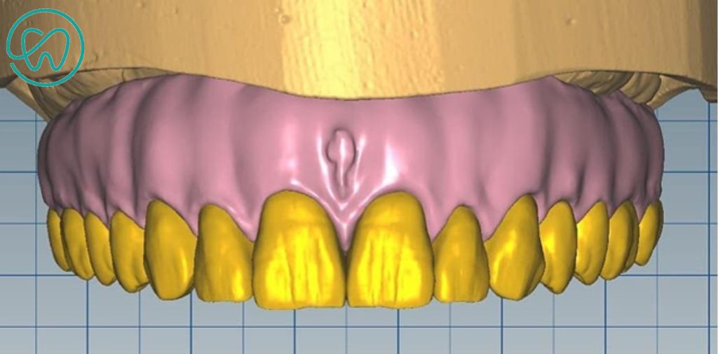 Enceramento digital para protocolo maxilar em zircônia