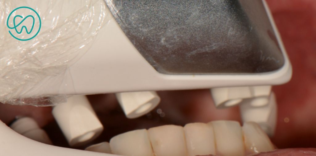 Escaneamento dentario para confecção das próteses sobre implante