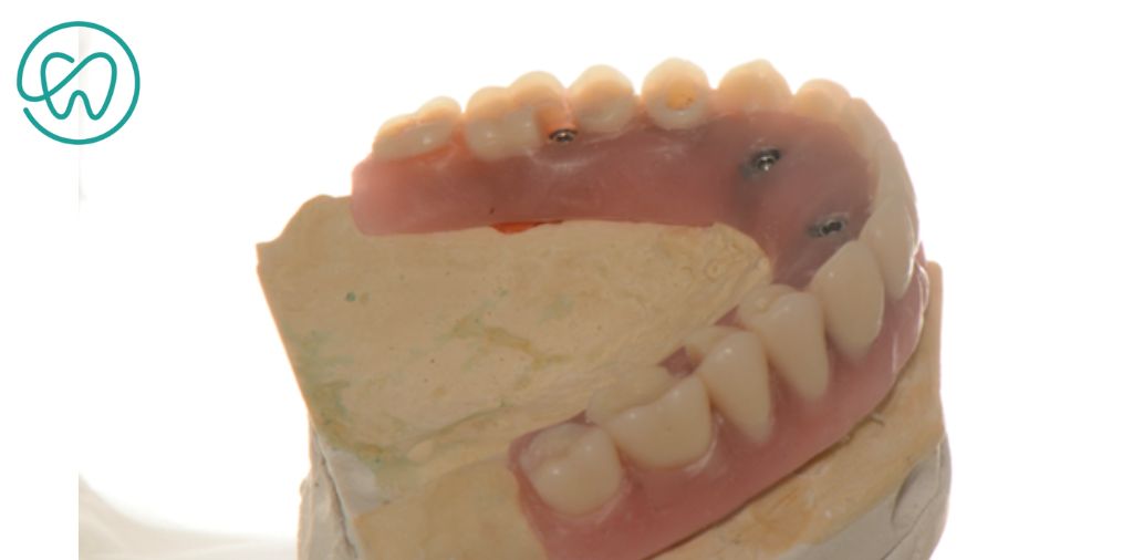 barra de dentes protese sobre implante