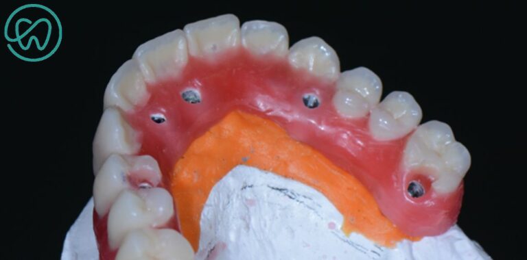 Existem diferenças entre as opções de dentes nos protocolos acrílicos?