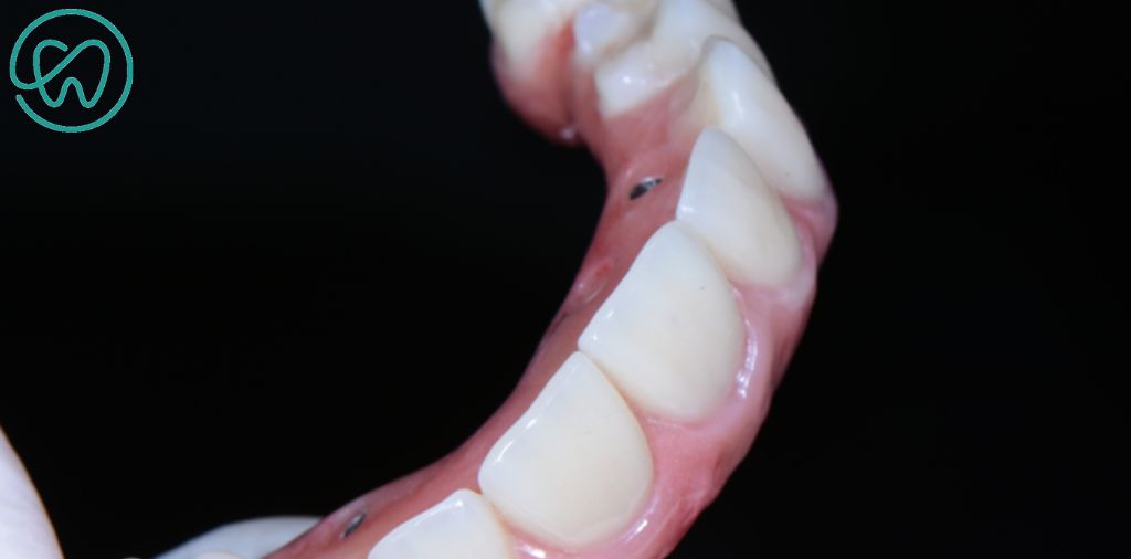 diferencas entre os dentes de resina