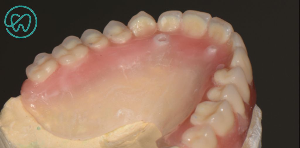 montagem dos dentes protese sobre implante